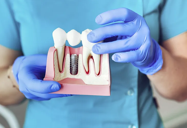 Implantología Oral Bogotá